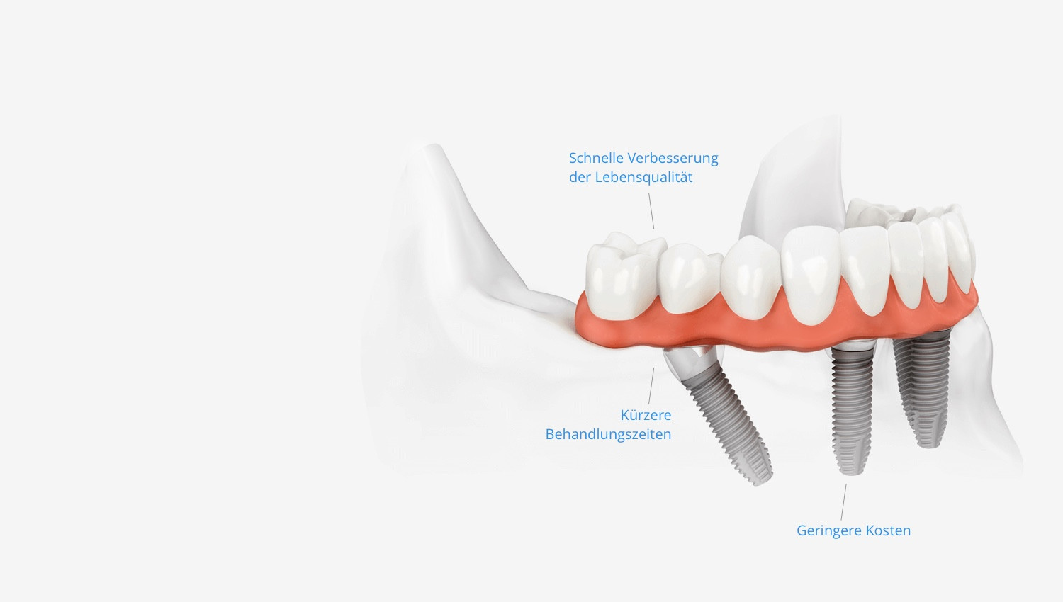 implantate-all-on-4