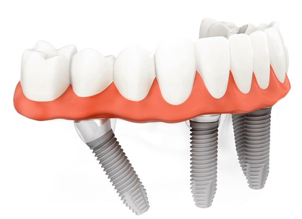 All-on-4 Implantate