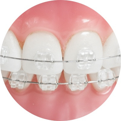 Keramik Brackets
