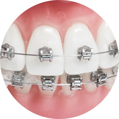 Metall Brackets