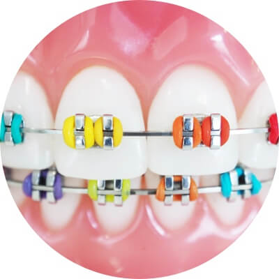 Metall Brackets mit bunten Gummies