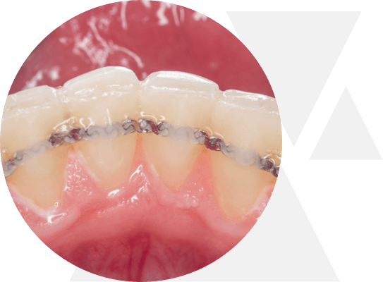 Kieferorthopädie Retainer