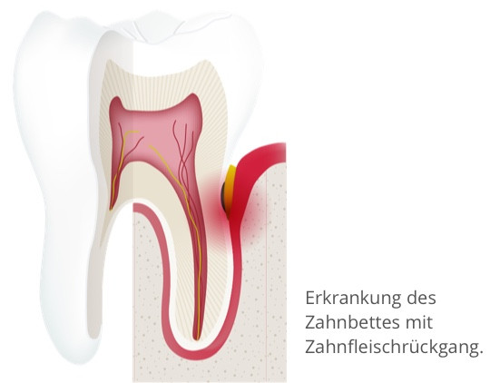 Erkrankung des Zahnbetts mit Zahnfleischrückgang