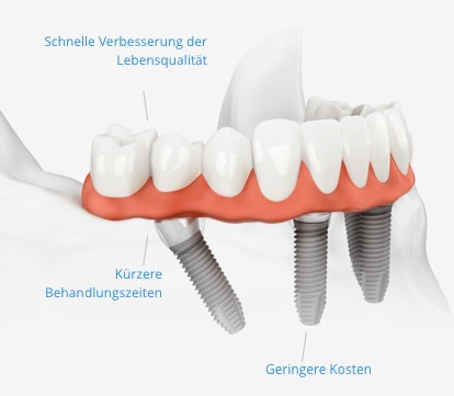 start_implantate-all-on-4