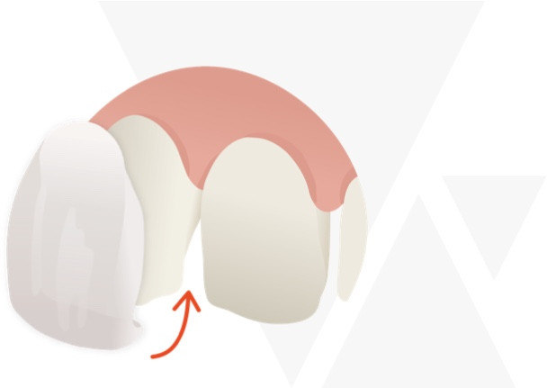 Veneer Behandlung Schritt 1