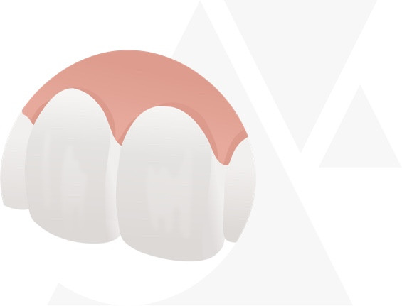 Veneer Behandlung Schritt 2